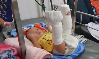 Bé trai 4 tháng tuổi nghi bị cha đánh xuất huyết não