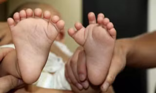 Bé trai có tổng cộng 16 ngón trên bàn tay và 15 ngón chân nhưng lại không có ngón tay cái hay ngón chân cái nào.