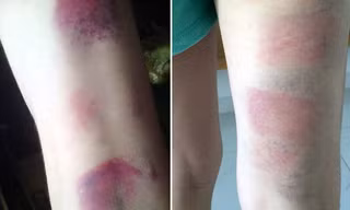 Chân học sinh được cho là giáo viên đánh