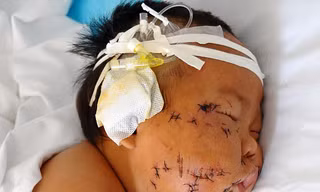 Em bé bị mẹ dùng kéo đâm nát mặt