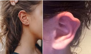 Bị nhiễm trùng khi bấm lỗ tai, nữ sinh phải phẫu thuật lấy khuyên ra và bị biến dạng tai