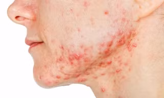 Sắp có vắc xin ngừa mụn trứng cá