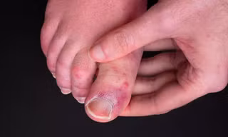 Nhiều người sau khi mắc COVID-19 lại bị phát ban ở ngón chân.
