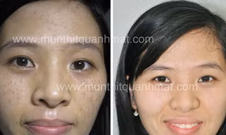 Nhiều bạn trẻ đau khổ vì mụn thịt