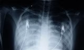 Bé gái mắc bệnh hiếm : 1 triệu người mới có người mắc