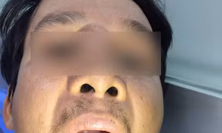 Tưởng cảm sốt thông thường, hóa ra suýt chết vì bạch hầu