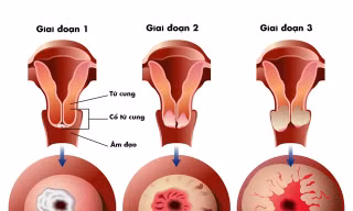 “Hiện thực hóa” ước mơ có con của bệnh nhân ung thư cổ tử cung
