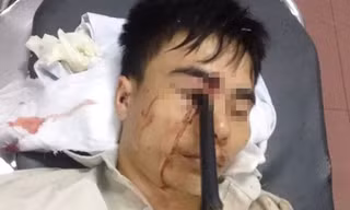 Cầm ô đi xe máy, thanh niên bị cán gương đâm xuyên mắt