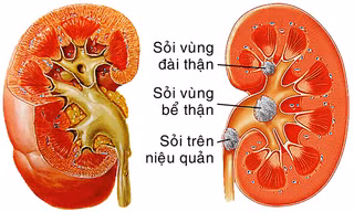 Sỏi thận - Ngăn ngừa tái phát trong điều trị