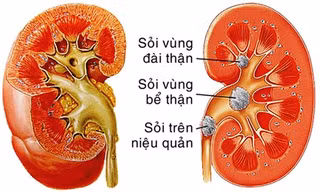 Sỏi thận - Ngăn ngừa tái phát trong điều trị