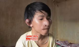 Cuộc sống cơ cực của cậu bé “Trư Bát Giới” bị cha bỏ rơi