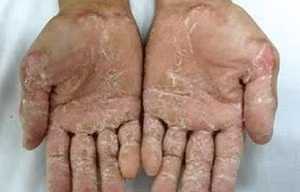 Quảng Ngãi cấp gạo, thuốc cho người bị bệnh viêm da