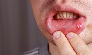 Bác sĩ cảnh báo những bệnh có thể lây khi quan hệ tình dục bằng miệng