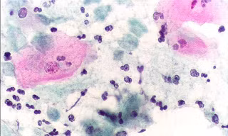 Trị viêm âm đạo do Trichomonas