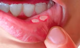 Cách xử lý nhiệt miệng tại nhà cực đơn giản