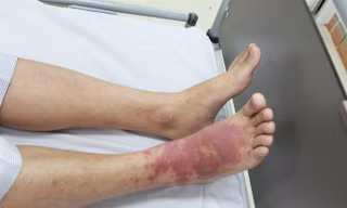 Những ai dễ bị lây bệnh liên cầu lợn?