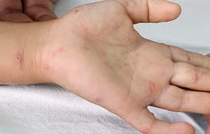 Hơn 87 nghìn người mắc bệnh chân tay miệng