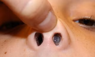 Những vị trí khó ngờ tiết lộ ung thư
