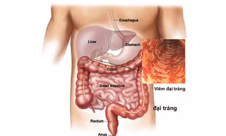 5 dấu hiệu giúp tự nhận biết sớm ung thư đại trực tràng