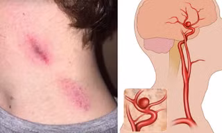 Động mạch cảnh là nơi rất nhạy cảm ở cổ