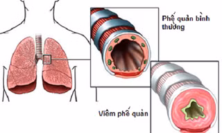 8 món cháo ngon chữa viêm khí quản, ho lâu ngày