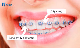 Niềng răng mắc cài kim loại thường