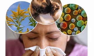 5 mẹo tự chữa dị ứng hiệu quả tại nhà