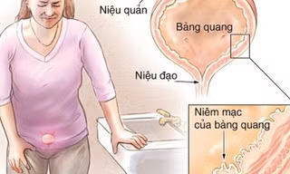 12 bài thuốc hỗ trợ điều trị viêm bàng quang cực hiệu quả