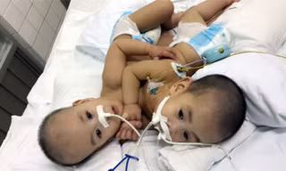 Hai Bé Long-Phụng khi chưa được tách rời.