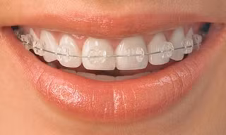 Những vấn đề thường gặp khi nắn chỉnh răng