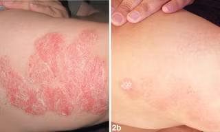 Hướng điều trị mới cho bệnh vẩy nến