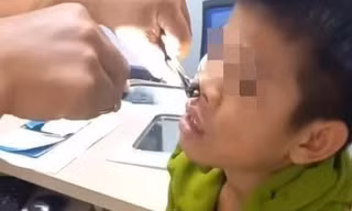 Gắp vắt dài 8cm 'ngoe nguẩy' trong mũi nam thiếu niên
