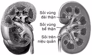 Sỏi thận - Ngăn ngừa tái phát trong điều trị
