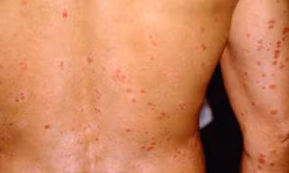 Vẩy nến trên lưng và tay