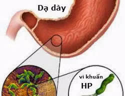 Tai biến là nguyên nhân gây tàn phế và mất trí nhớ ở nhiều người trưởng thành. (Ảnh minh hoạ: IE)