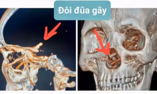 Ảnh ct hộp sọ