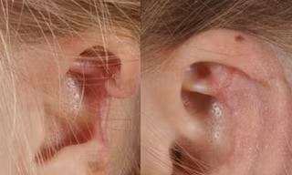 Mất một phần tai vì bị nhện cắn