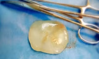 "Viên ngọc" rơi ra từ bụng sản phụ trong quá trình mổ đẻ ở Trung Quốc.