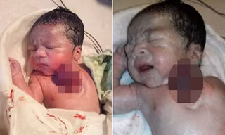 Bé gái sinh ra có trái tim nằm ngoài lồng ngực