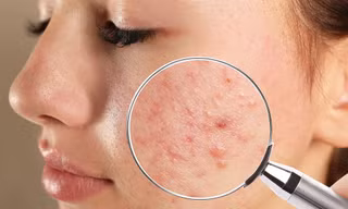 Xác định đúng loại "đèn pin" đang mắc phải sẽ giúp bạn điều trị mụn hiệu quả hơn