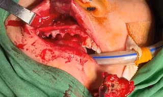 Bác sĩ nhổ hết răng loại bỏ xương chết cho bệnh nhân