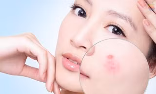 Serum tái tạo da Hoàng Thiên Sâm giải quyết mọi vấn đề của da mụn