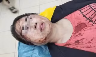 Người phụ nữ bị chồng bạo hành nhập viện trước ngày ly hôn
