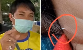Hóc xương cá nhưng mặc kệ, một người bị cái xương xuyên qua da, “ló” ra ngoài