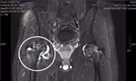 Bác sĩ ngoại quốc chẩn đoán sai, Việt kiều về nước được điều trị khỏi bệnh 