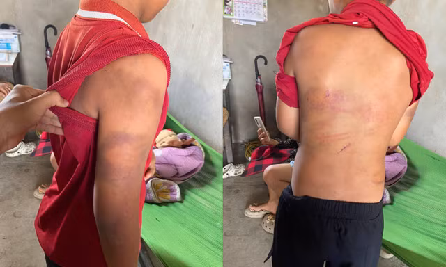Công an vào cuộc xác minh vụ cháu bé đầy vết bầm tím trên cơ thể