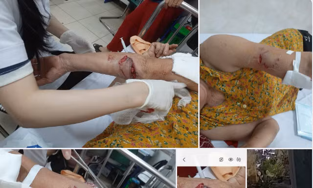 Chó lạ hung hãn tấn công 3 phụ nữ đi tập thể dục