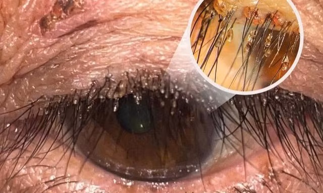 Phát hiện rận mu ký sinh dày đặc trên lông mi người phụ nữ