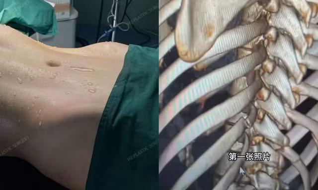 Xu hướng bẻ xương sườn để có vòng eo con kiến
