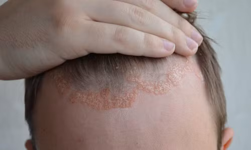 Triệu chứng vảy nến da đầu